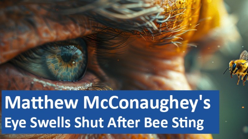 Matthew McConaughey's Eye Swells Shut After Bee Sting