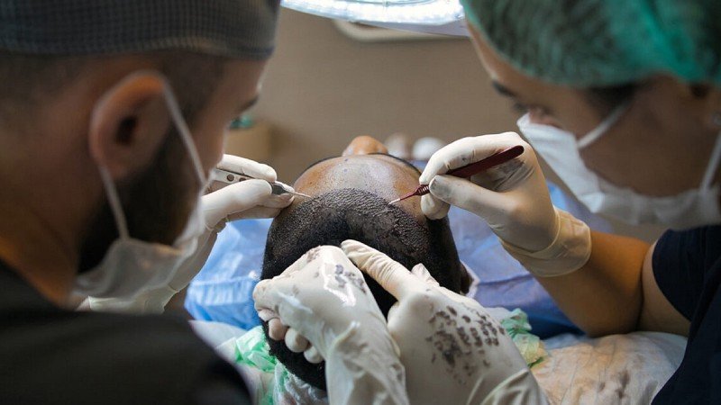 Tips for Choosing the Best Hair Transplant Doctor