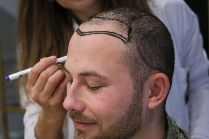 The Life-Changing Benefits of Hair Transplants You Can’t Ignore